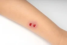 سانپ کے ڈسنے