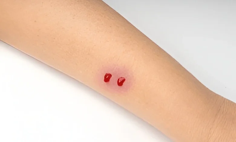 سانپ کے ڈسنے